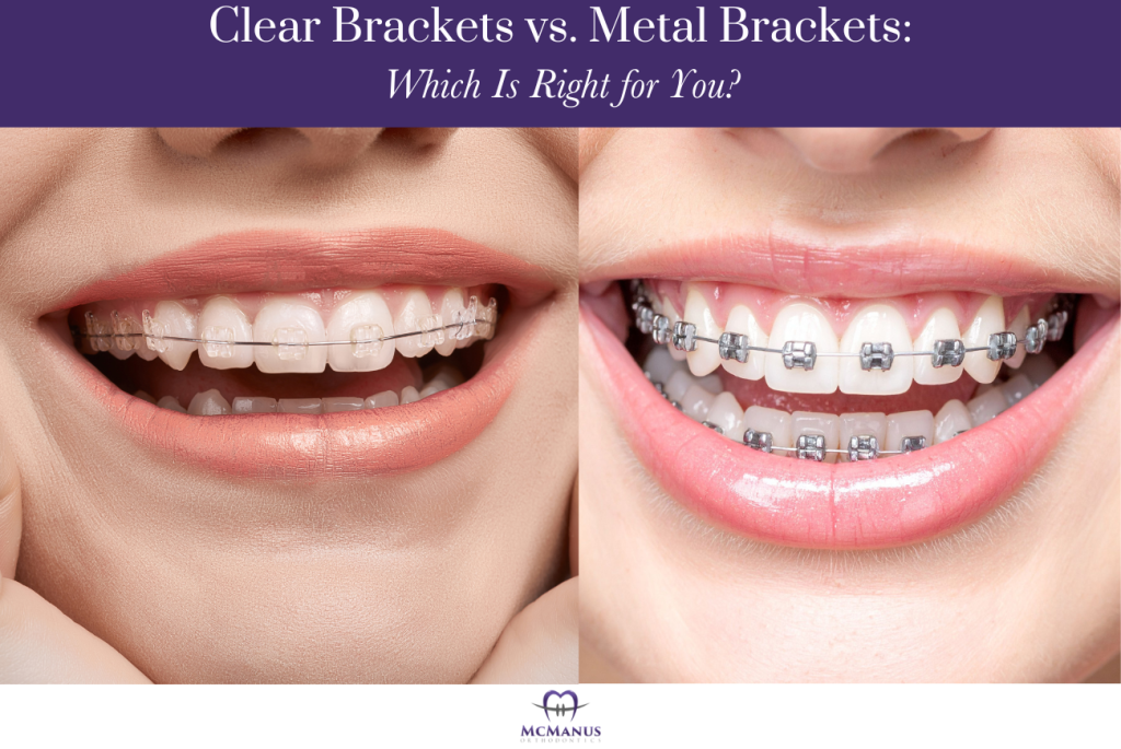 Clear Brackets vs. Metal Brackets Which Is Right for You